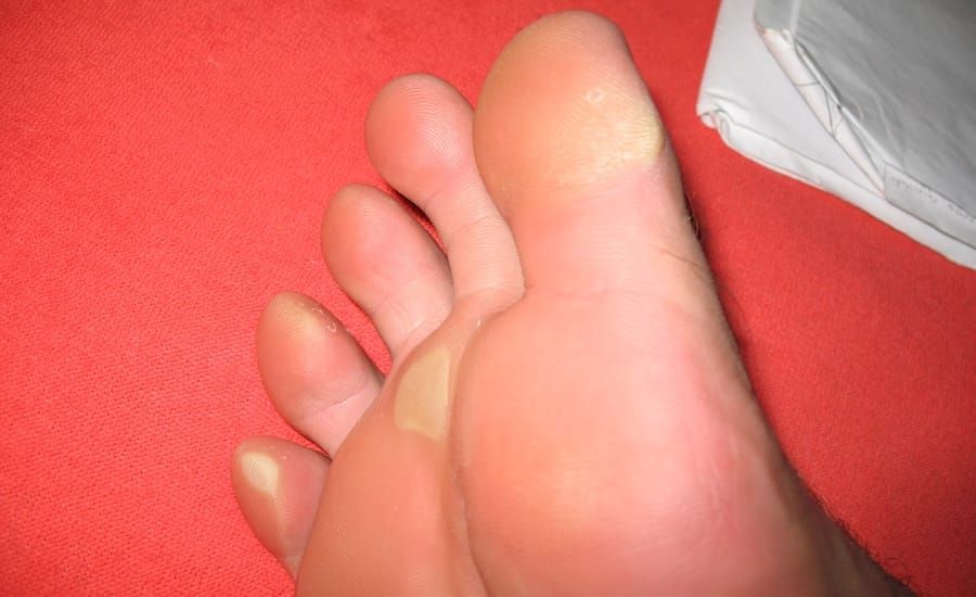 Corns and Calluses