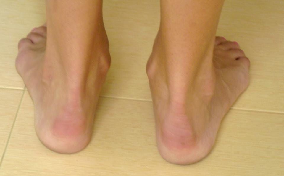 Flat Feet