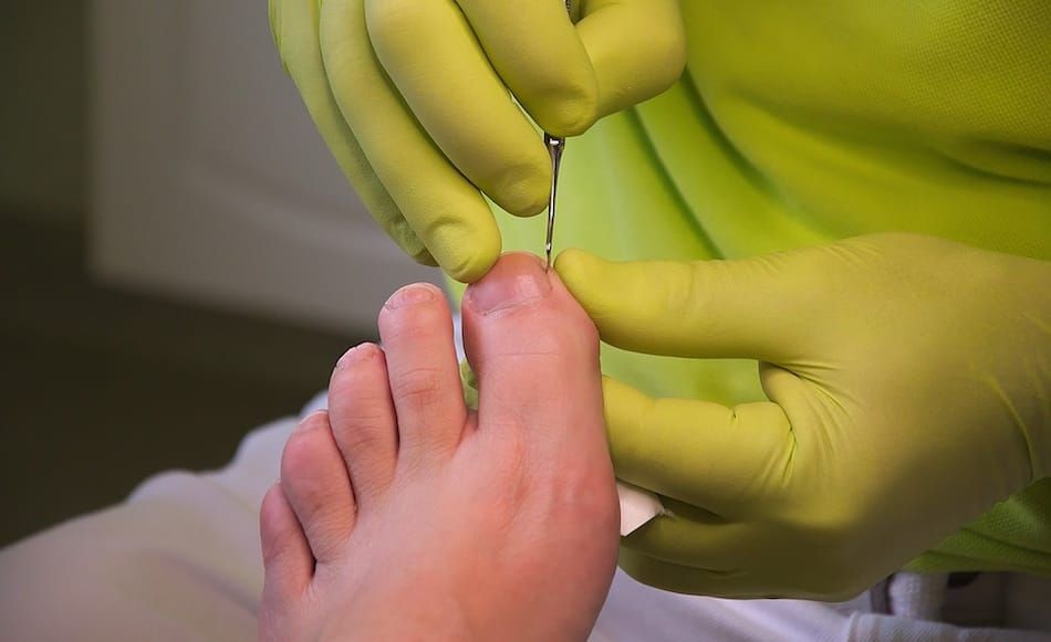 Ingrown Toenails